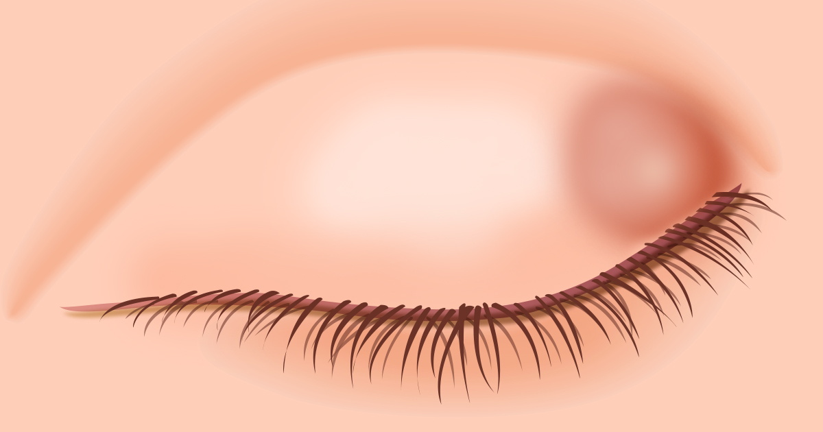  A common eyelid bump may be a chalazion. 