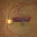 diabetic retinopathy