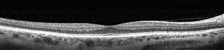 healthy retina photo