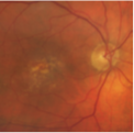 macular degeneration